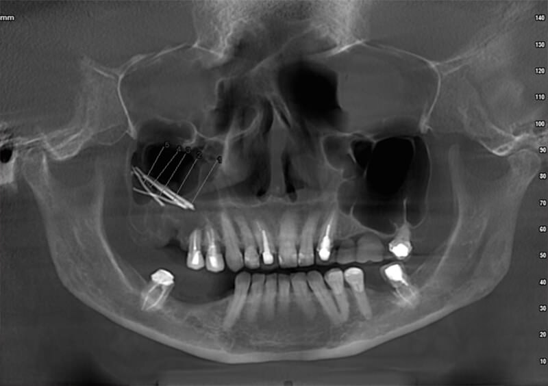Figura 1. Radiografía panorámica: Conos de gutapercha, comunicación oroantral en el seno maxilar derecho. Fuente propia