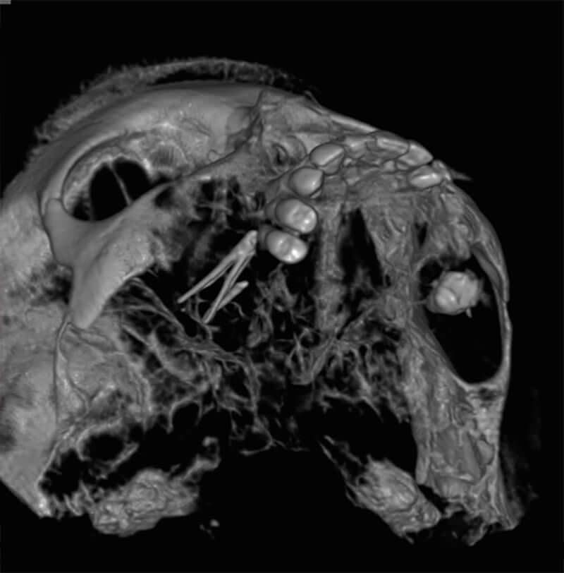 Figura 2. Imagen 3D mediante tomografía volumétrica: Conos de gutapercha en el seno maxilar derecho, comunicación oroantral. Fuente propia