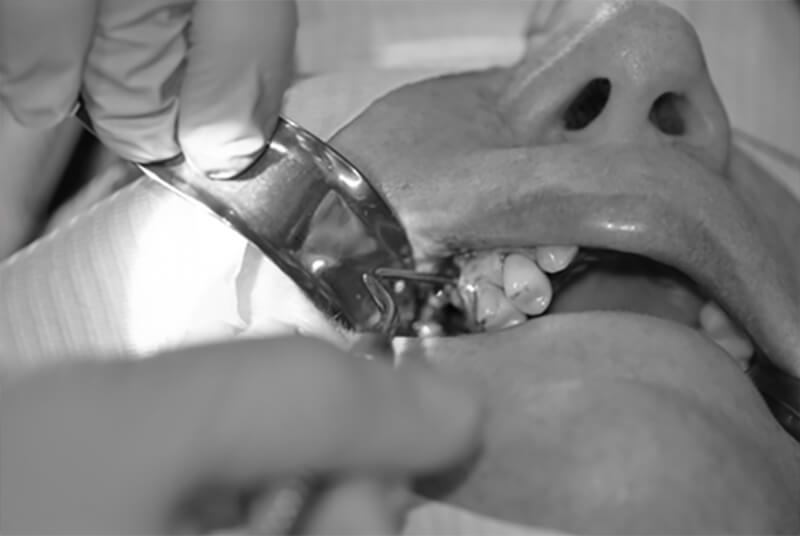 Figura 3. Curetaje para retiro del cuerpo extraño en seno maxilar. Fuente propia