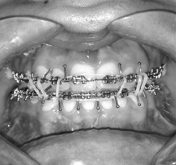 Figura 10: Fotografía intraoral Fuente: Propia