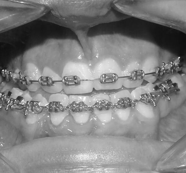 Figura 4: Fotografía intraoral Fuente: Propia