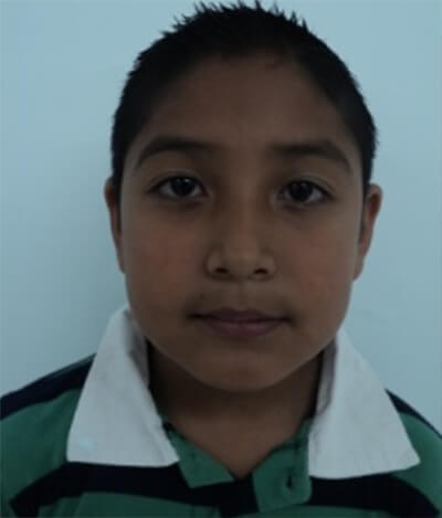 Fig. 1 Paciente de 8 años y 2 meses de edad, fotografías de frente, perfil, lateral derecha e izquierda del caso antes del inicio del tratamiento.