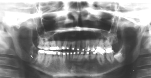 Figura 2 Radiografía panorámica preoperatoria