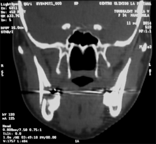 Figura 3 Tomografía computarizada, 15 días después de la extracción del tercer molar. Corte coronal