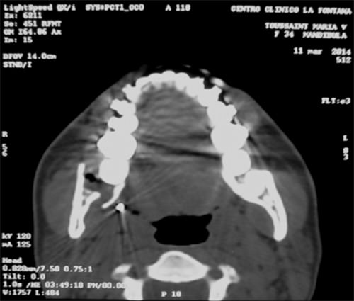 Figura 4 Tomografía computarizada, 15 días después de la extracción del tercer molar. Corte axial