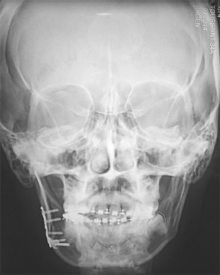 Figura 6 Radiografía PA post-quirúrgica.