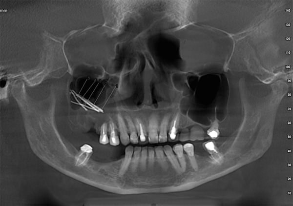 Figura 1 Radiografía panorámica: Conos de gutapercha, comunicación oroantral en el seno maxilar derecho. Fuente propia