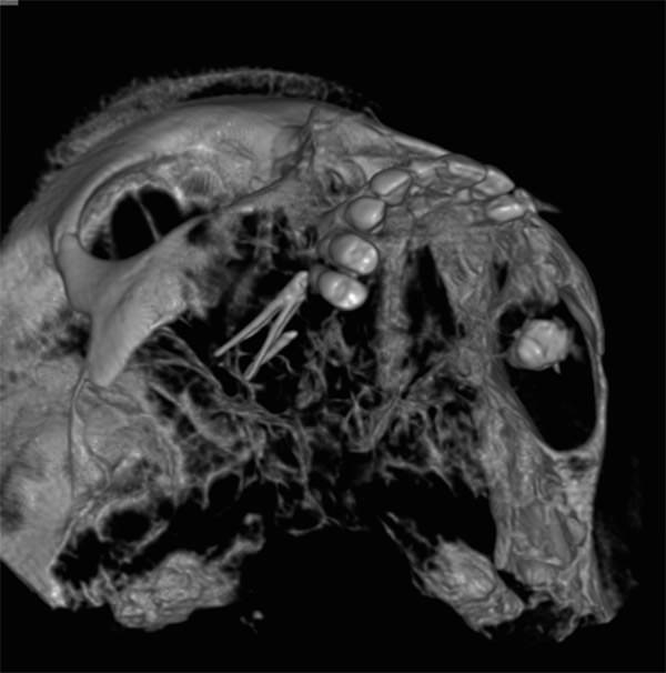 Figura 2 Imagen 3D mediante tomografía volumétrica: Conos de gutapercha en el seno maxilar derecho, comunicación oroantral. Fuente propia