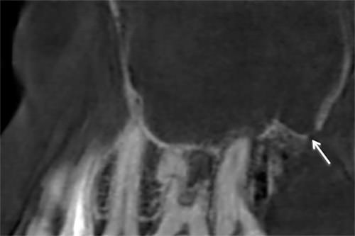 FIGURA 1 CBCT: Corte sagital del maxilar izquierdo. Obliteración del seno maxilar y perforación de cortical (flecha).