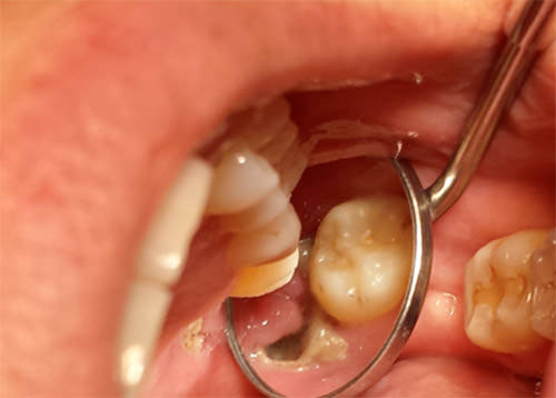 FIGURA 2 Zona de tejido óseo necrótico en relación a alvéolo del tercer molar superior izquierdo.