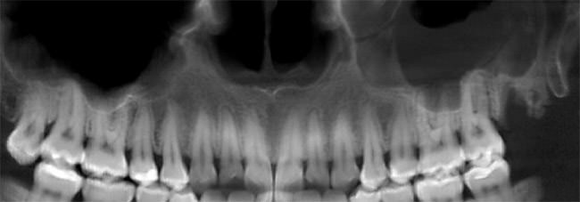 FIGURA 3 CBCT, Reconstrucción panorámica: Completa opacificación del seno izquierdo.