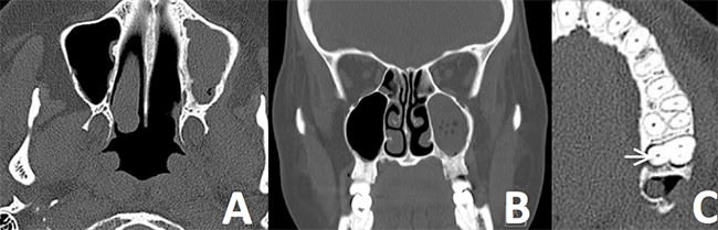 FIGURA 4 Tomografía computada realizada a los 6 meses de la intervención quirúrgica. En A y B se observa una completa ocupación del seno. En C se aprecia la comuniciación al seno a través del alvéolo y el engrosamiento del ligamento periodontal en el diente adyacente (flecha).