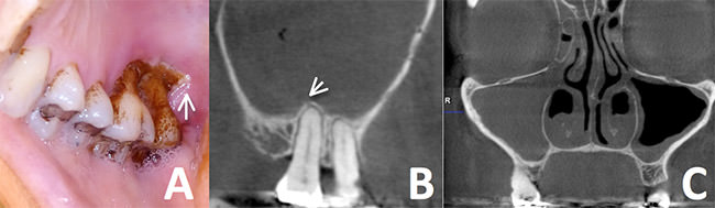 FIGURA 5 Caso Clínico 3. Mujer 51 años de edad, sinusitis maxilar derecha en relación a ONMF post curetaje periodontal. En A pus drenando por el crevice del segundo molar (flecha) ampliamente teñido por la clorhexidina. En B, comunicación del segundo molar con el seno (punta de flecha). En B y C velamiento completo del seno.