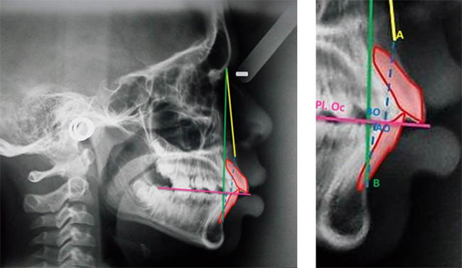 Fig. 2: Observar dos líneas perpendiculares, las cuales se proyectan desde los puntos A y B sobre el plano oclusal: AO (Punto A perpendicular al Plano Oclusal) y BO (Punto B perpendicular al Plano Oclusal) 11.