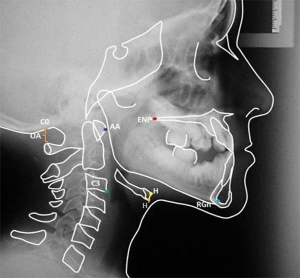 Fig. 3: Puntos del Trazado Cefalométrico de Rocabado.