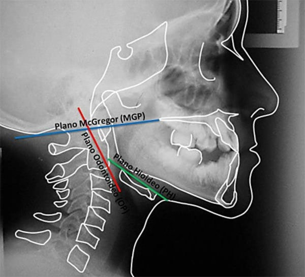 Fig. 4: Planos del Trazado Cefalométrico de Rocabado.