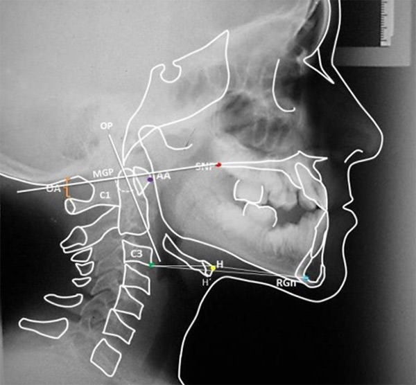 Fig. 6: Trazado Cefalométrico de Rocabado.