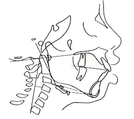 Fig. 7: Curvatura Cervical normal, triángulo hioideo positivo.