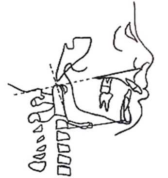Fig. 8: Relación cráneovertebral normal. Columna vertebral recta y el hioides situado en el plano C3-RGn.
