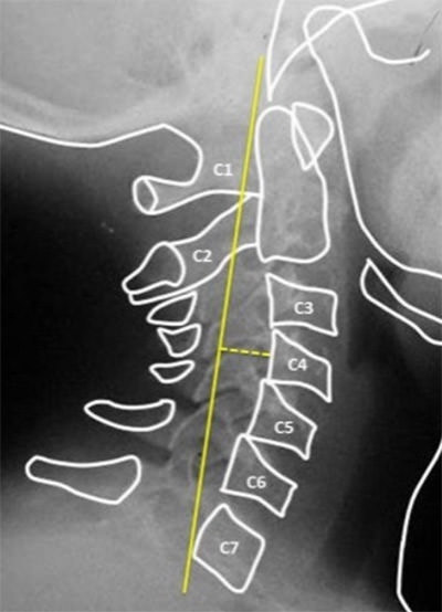 Fig. 9: Medición de la profundidad de la columna cervical.