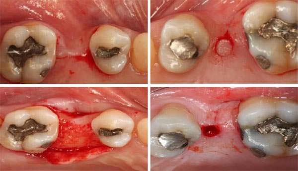 Figura 2 Incisión y despegamiento del colgajo en la cirugía convencional(a,b). Remoción de la mucosa, a través del extractor de mucosa 1 y 2 en la cirugía guiada(c,d).