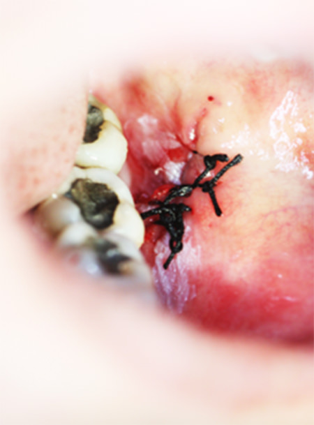 Fig. 3 Biopsia incisional