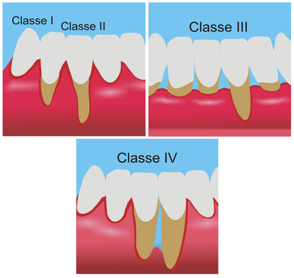 Figura1: Clase I - la recesión gingival no involucra la línea mucogingival y no hay pérdida tisular interdentaria, Clase II - la recesión involucra o sobrepasa la línea mucogingival, no existiendo todavía pérdida de tejido interdentario. Clase III - la recesión involucra o sobrepasa la línea mucogingival, existiendo pérdida de tejido interdentario posicionado coronalmente a la base de la recesión. Clase IV - la recesión involucra o sobrepasa la línea mucogingival y los tejidos proximales están situados a nivel de la base de la recesión, involucrando más de una superficie del dente.