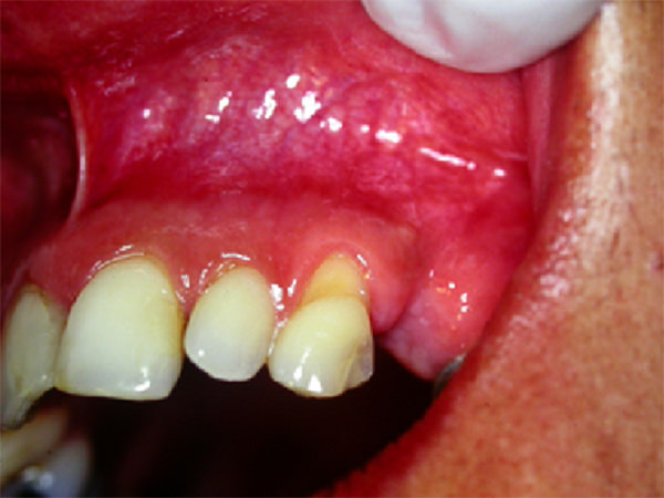 Figura 2 Caso 1 - recesión gingival Clase I de Miller en el 23.