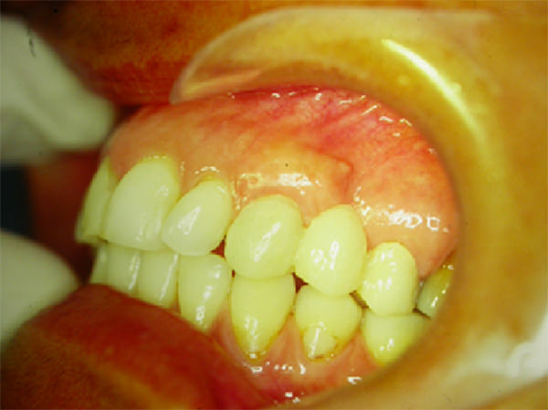 Figura 3 Caso 1 - 60 días postoperatorio, injerto de tejido conjuntivo, se realizó la preparación dentaria y la colocación de una prótesis provisional.