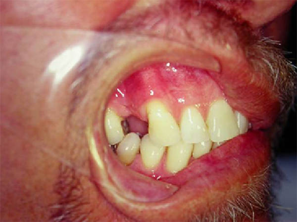 Figura 4 Caso 2 - recesión gingival Clase I de Miller en el 13.