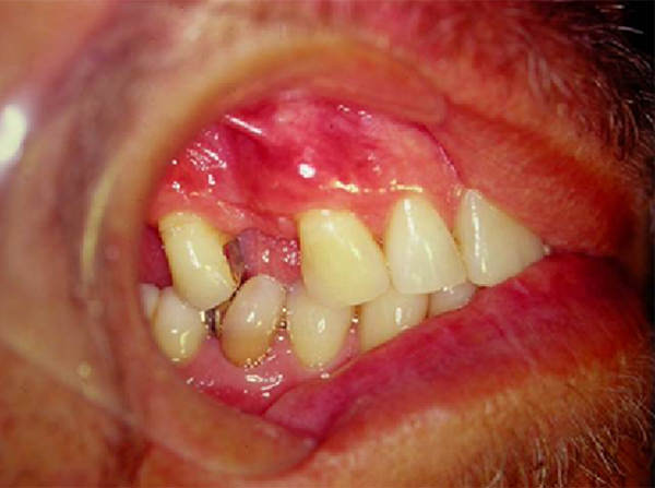 Figura 5 Caso 2 -una capa más espesa de mucosa queratinizada está asociada al recubrimiento estético radicular