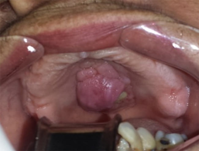 Figura 1 Pérdida de la continuidad de la mucosa palatina