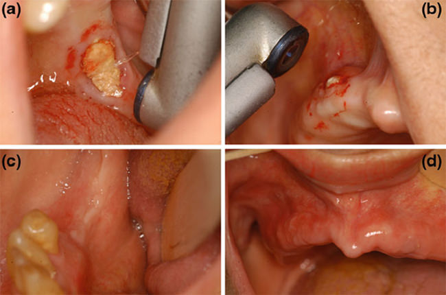Figura 1 a- Vaporización del hueso necrótico mandibular con láser ER:YAG (sin contacto). b- Vaporización de hueso necrótico maxilar usando láser ER:YAG. c- 1 mes después de la aplicación del láser que muestra una completa curación del sitio tratado en (a). d- 1 mes después de la aplicación del láser, se muestra una completa curación del área maxilar tratada en (b). (Fuente: Biphosphonates and Osteonecrosis of the jaw: A Multidisciplinary Approach. Pag.132)