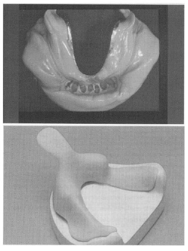 Figura 1 Impresión anatómica con técnicas de cubeta individualizada.