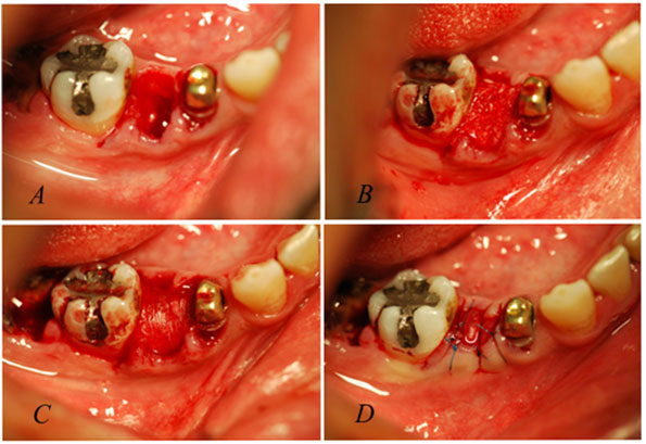 Figura 1 Fotografías clínicas de la secuencia quirúrgica: A: alveolo post extracción. B: Aloinjerto de matriz ósea en polvo. C: Cobertura con lámina cortical. D: Sutura a puntos separados. La membrana permanece expuesta al medio bucal.