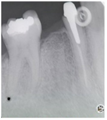Fig 11 Rx periapical de control al año. Nótese la cortical formada en la cresta del reborde