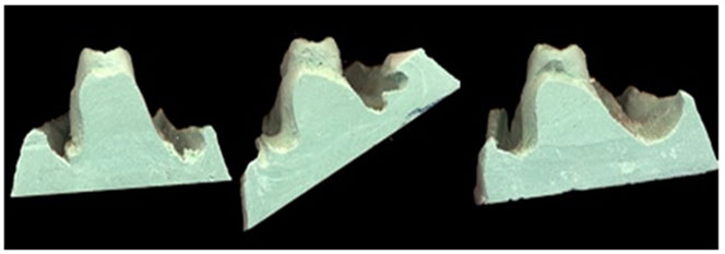 Fig 3 Cortes transversales en modelos de yeso en tres etapas (0, 120 y 360 días) del mismo paciente.