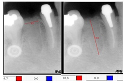 Fig 6 Radiovisiografía con medidor de distorsión para registro del alto y largo alveolar.