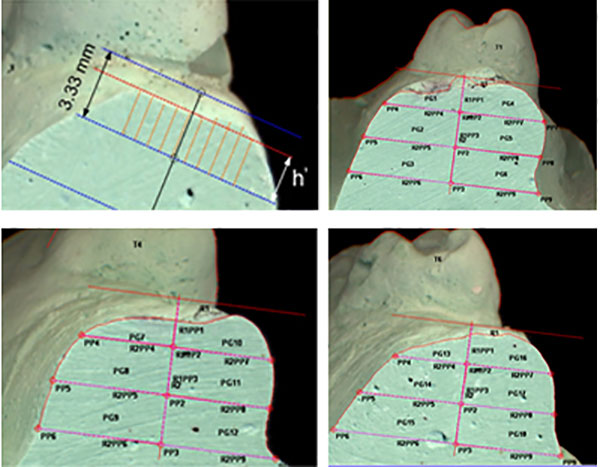 Fig 7 Cortes transversales en modelos de yeso en tres etapas (0, 120 y 360 días) correspondientes al mismo paciente).