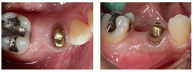 Figuras 9 y 10 Vista oclusal y vestibular de la zona del elemento 45 a los 360 días del post operatorio que permite observar las características del reborde preservado