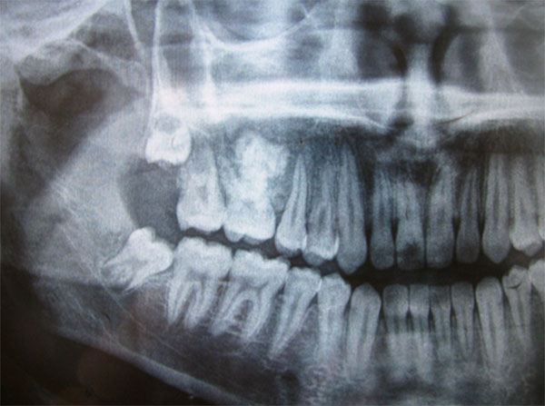 Fig. 2 Rx Panorámico, muestra una lesión radiopaca rodeada por un borde radiolúcido, en íntima relación con raíces de 1er molar superior derecho.