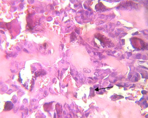 Fig. 5 A mayor aumento se aprecian osteoblastos redondeados y prominentes indicativos de proliferación.
