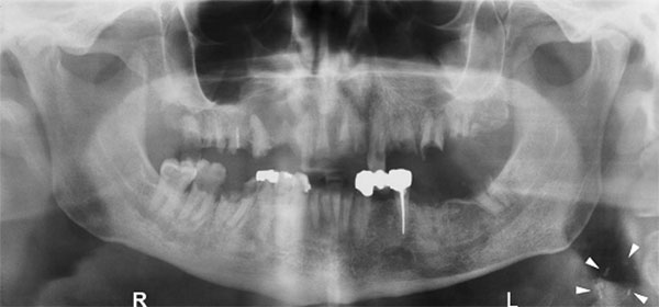 Figura 1 Presencia de placas ateroscleróticas en radiografía panorámica. Fuente: Pornprasertsuk-Damrongsri et al, (2009), p. e5911.