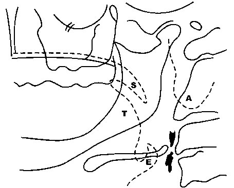 Figura 2 Dibujo ilustrativo sobre localización de la placa de ateroma en la radiografía panorámica. Fuente: Carter et al., (1997), p. 98215.