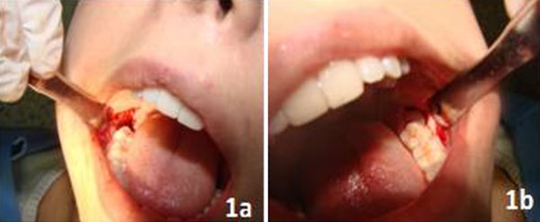 Figura 1 Implantación de los biomateriales. Implantación de membranas de quitosano (1a). Implantación de PRF (1b).