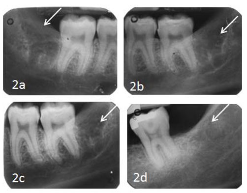 Figura 2 Radiografías periapicales representativas a la clasificación de la regeneración ósea: Grado 0 (2a), Grado 1 (2b), Grado 2 (2c) y Grado3 (2d).