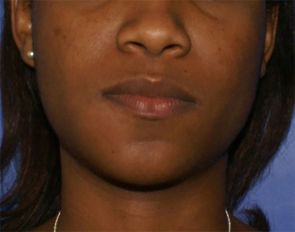 Ligera asimetría facial mandibular derecha