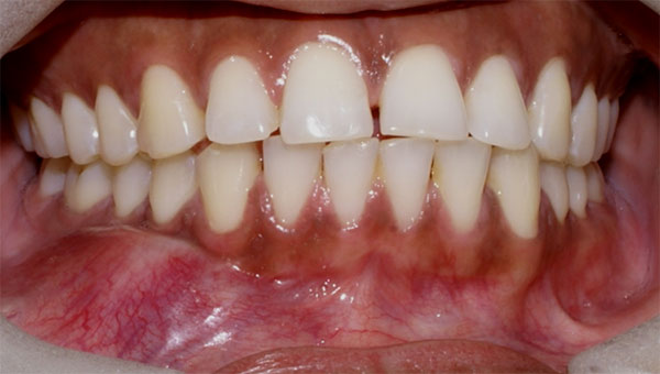 Aumento de volumen en fondo de vestíbulo mandibular derecho