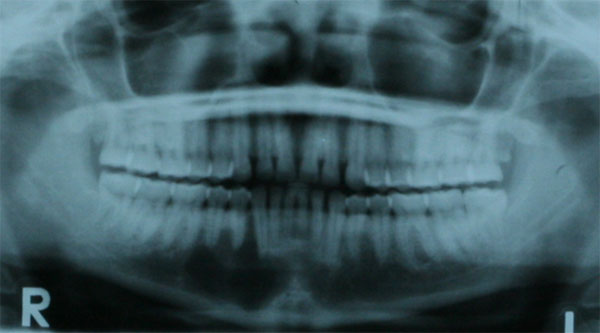 Radiografía Panorámica