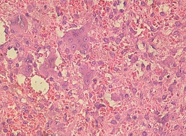 Foto microscópica que muestra las células gigantes multinucleadas